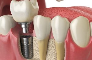 Affordable Dental Implants Melbourne