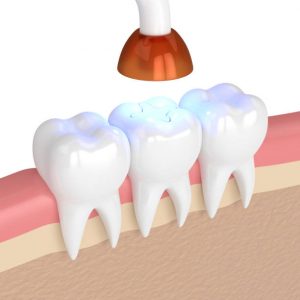Teeth White Filling