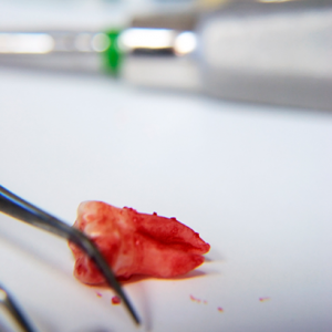 Wisdom Teeth Infection Treatment