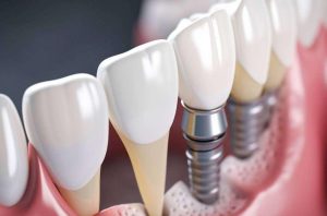 Arch Implants