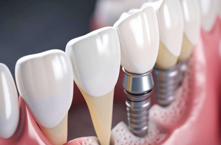 Arch Implants