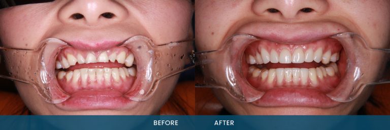 Porcelain Dental Veneers